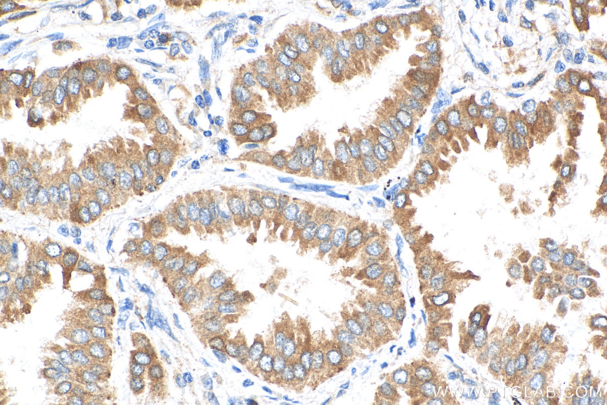 Immunohistochemistry (IHC) staining of human lung cancer tissue using PLA2G4A Monoclonal antibody (68133-1-Ig)