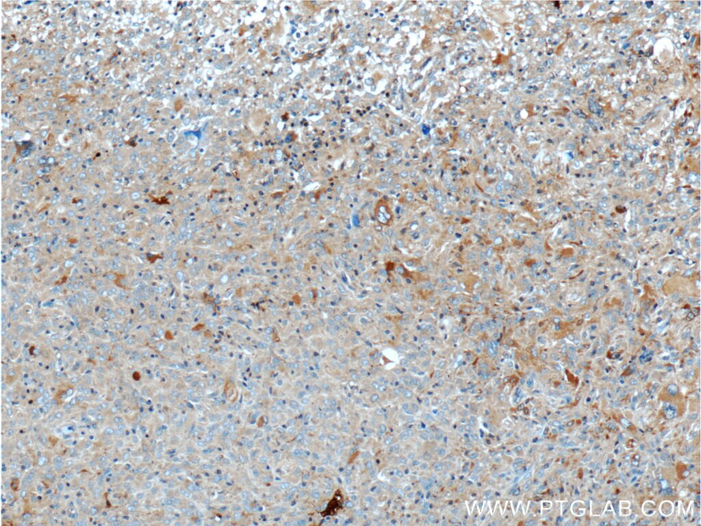 Immunohistochemistry (IHC) staining of human gliomas tissue using PLA2G4B Polyclonal antibody (55074-1-AP)