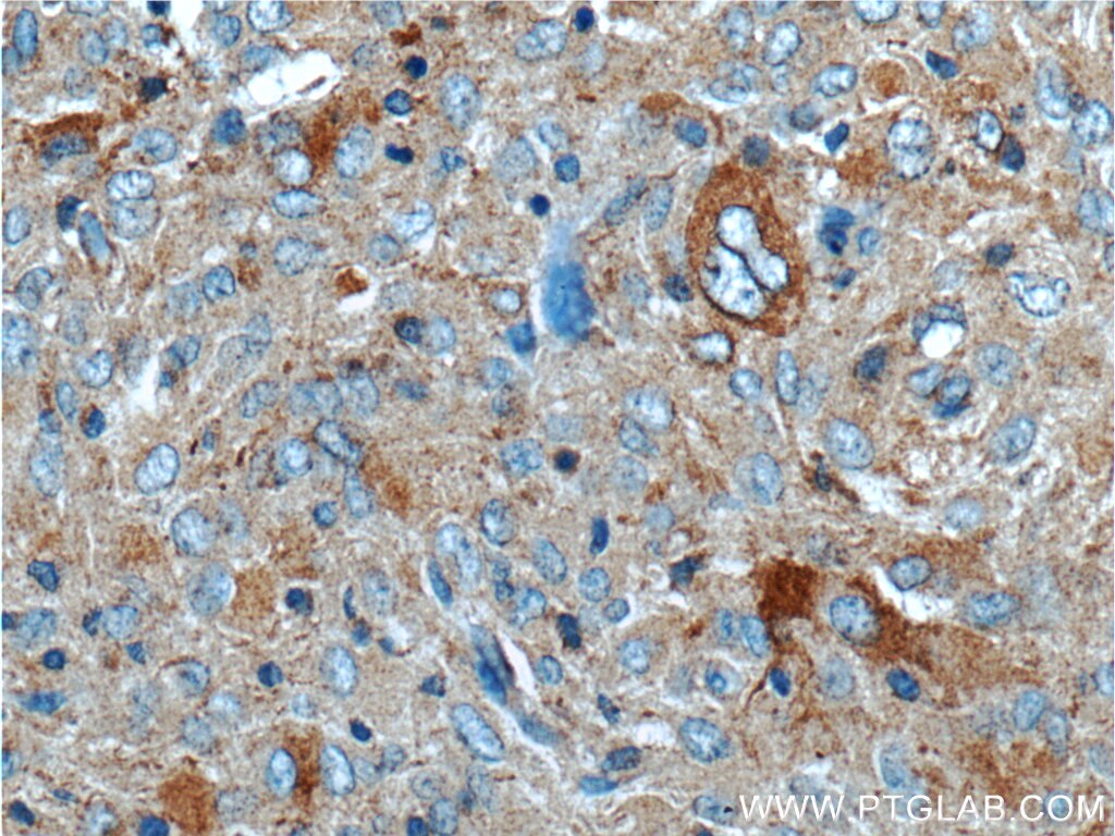 Immunohistochemistry (IHC) staining of human gliomas tissue using PLA2G4B Polyclonal antibody (55074-1-AP)