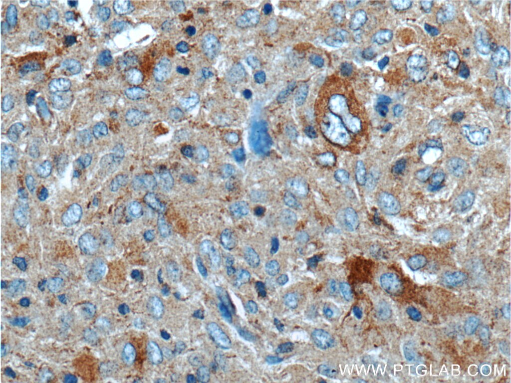 IHC staining of human gliomas using 55074-1-AP