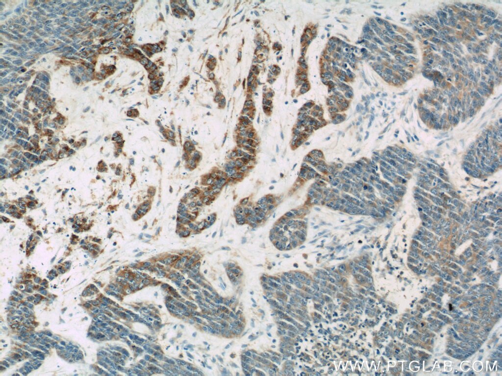 Immunohistochemistry (IHC) staining of human skin cancer tissue using PLA2G4D Polyclonal antibody (13345-1-AP)