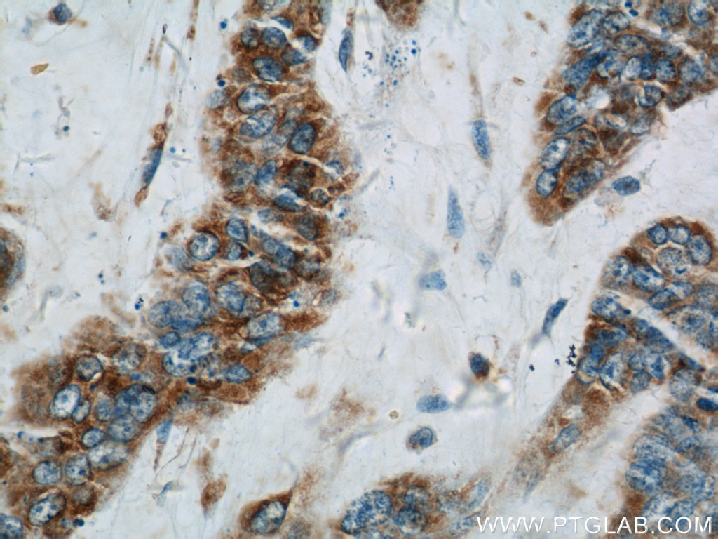 Immunohistochemistry (IHC) staining of human skin cancer tissue using PLA2G4D Polyclonal antibody (13345-1-AP)