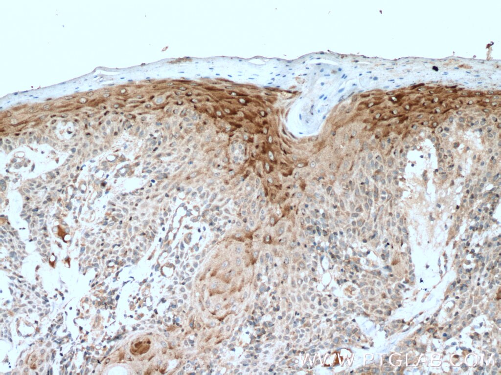 Immunohistochemistry (IHC) staining of human skin cancer tissue using PLA2G4D Polyclonal antibody (13345-1-AP)