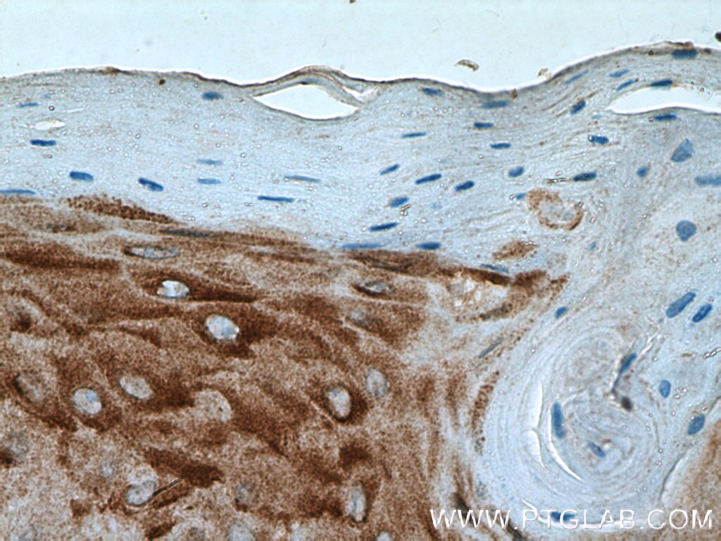 Immunohistochemistry (IHC) staining of human skin cancer tissue using PLA2G4D Polyclonal antibody (13345-1-AP)