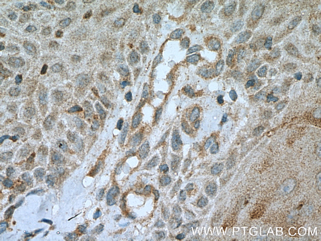 Immunohistochemistry (IHC) staining of human skin cancer tissue using PLA2G4D Polyclonal antibody (13345-1-AP)