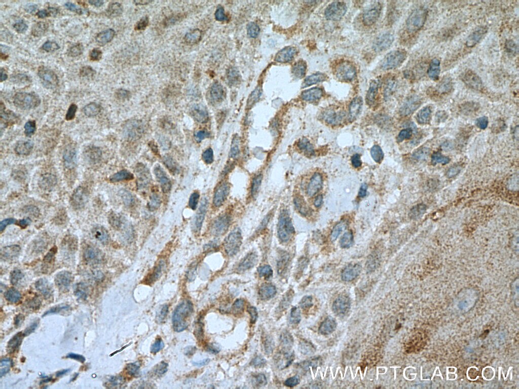 Immunohistochemistry (IHC) staining of human skin cancer tissue using PLA2G4D Polyclonal antibody (13345-1-AP)