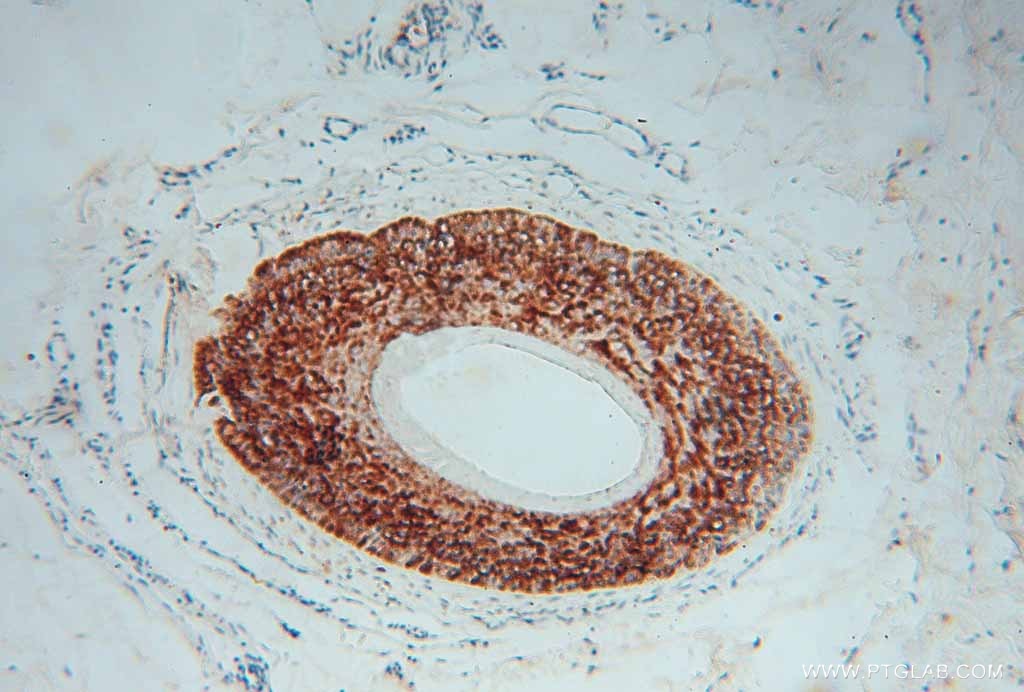 IHC staining of human skin cancer using 13345-1-AP