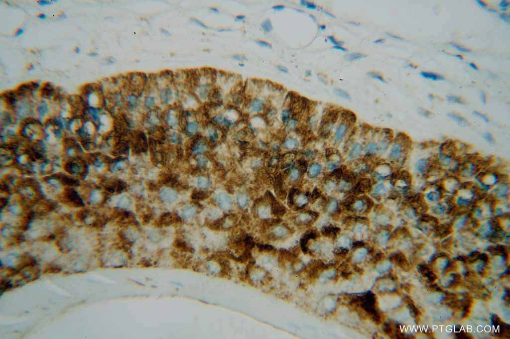 Immunohistochemistry (IHC) staining of human skin cancer tissue using PLA2G4D Polyclonal antibody (13345-1-AP)