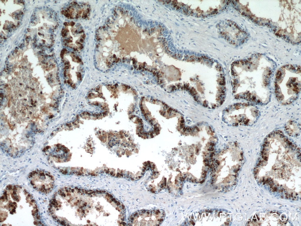 Immunohistochemistry (IHC) staining of human prostate hyperplasia tissue using PLA2G4F Polyclonal antibody (21411-1-AP)