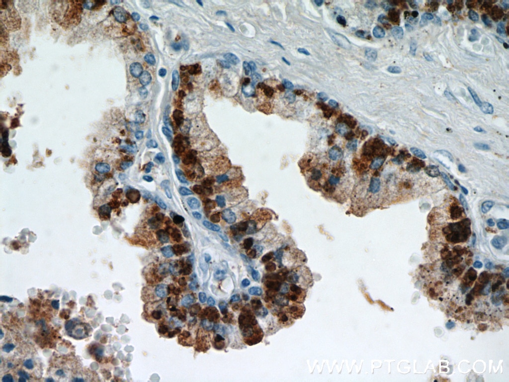 Immunohistochemistry (IHC) staining of human prostate hyperplasia tissue using PLA2G4F Polyclonal antibody (21411-1-AP)