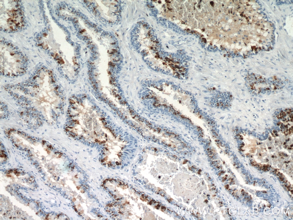 Immunohistochemistry (IHC) staining of human prostate hyperplasia tissue using PLA2G4F Polyclonal antibody (21411-1-AP)