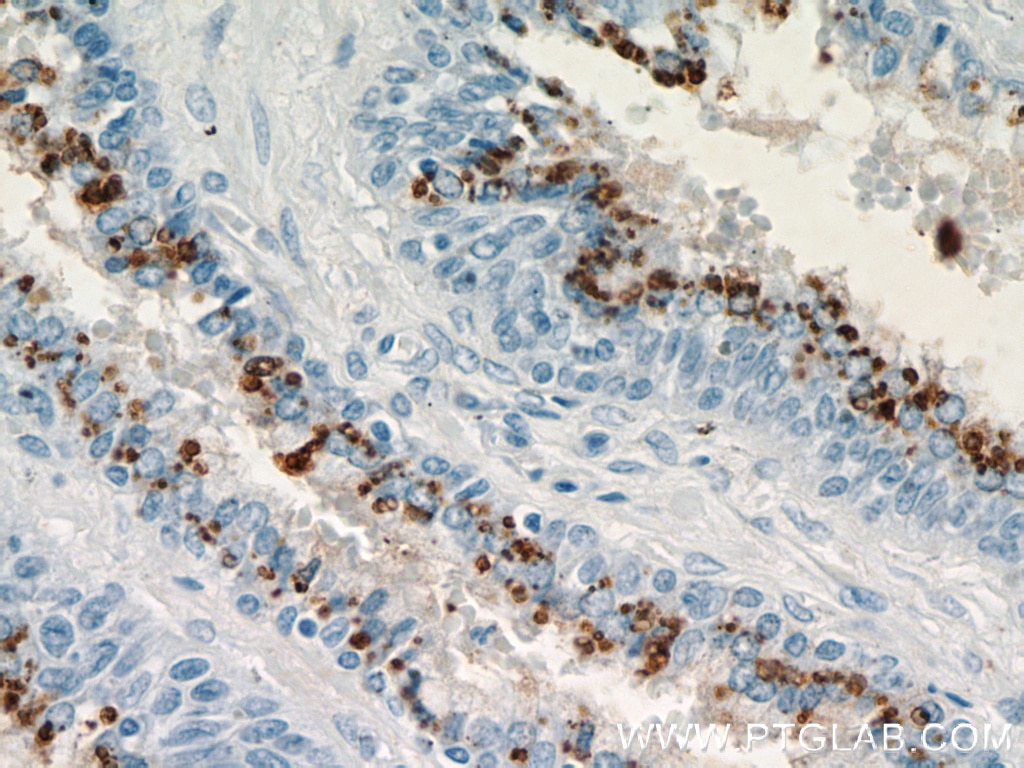 Immunohistochemistry (IHC) staining of human prostate hyperplasia tissue using PLA2G4F Polyclonal antibody (21411-1-AP)