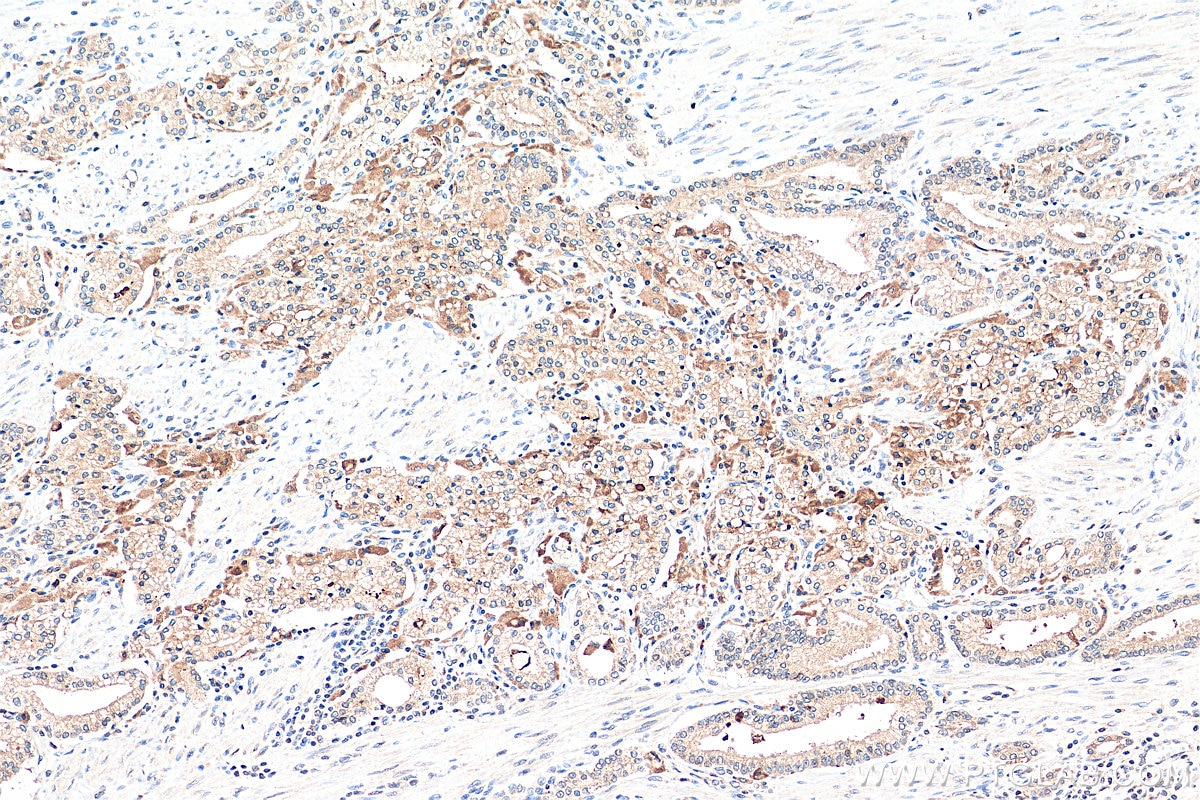Immunohistochemistry (IHC) staining of human prostate cancer tissue using PAFAH Polyclonal antibody (15526-1-AP)