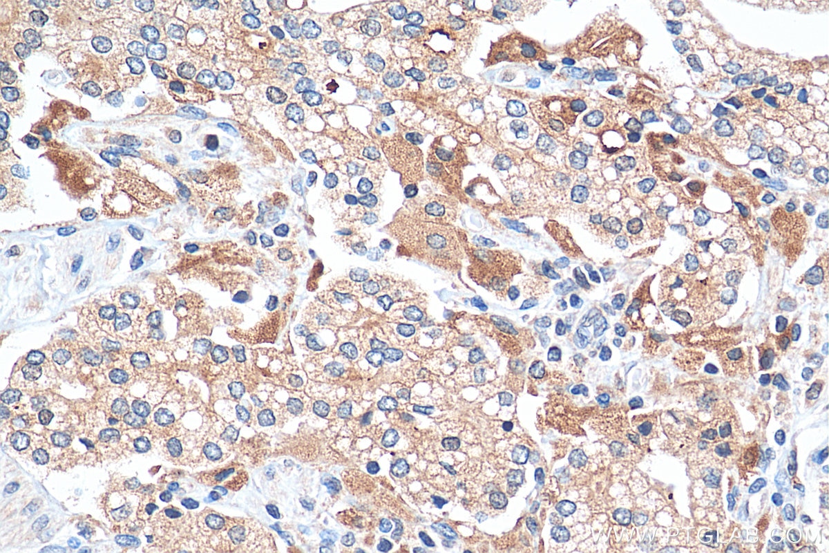 Immunohistochemistry (IHC) staining of human prostate cancer tissue using PAFAH Polyclonal antibody (15526-1-AP)