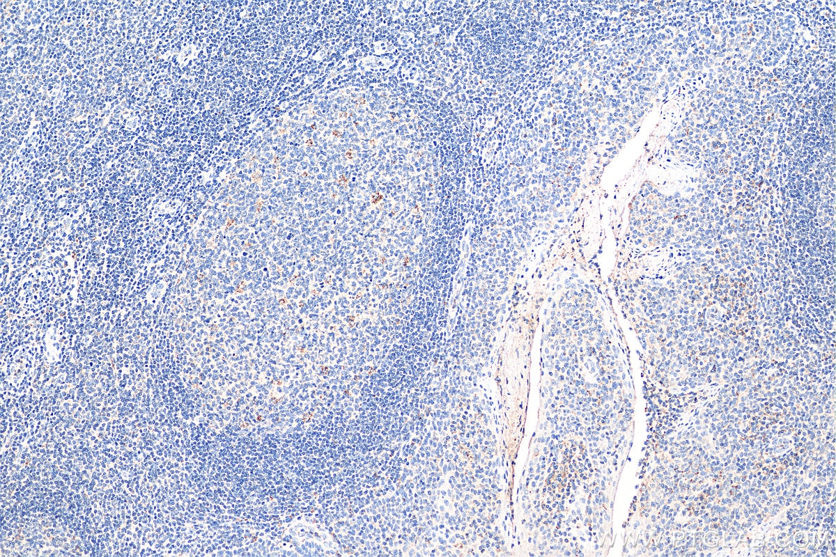 Immunohistochemistry (IHC) staining of human tonsillitis tissue using PAFAH Polyclonal antibody (15526-1-AP)