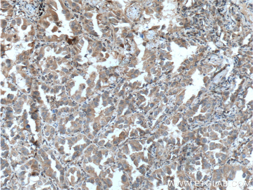 Immunohistochemistry (IHC) staining of human lung cancer tissue using PLAA Polyclonal antibody (12529-1-AP)
