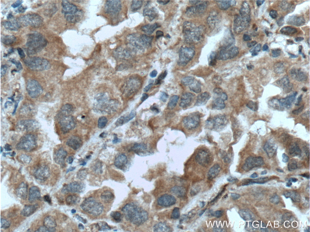 Immunohistochemistry (IHC) staining of human lung cancer tissue using PLAA Polyclonal antibody (12529-1-AP)