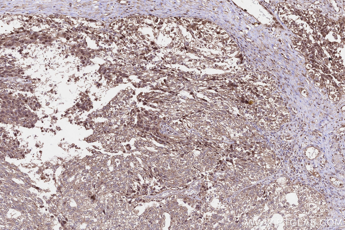 IHC staining of human ovary cancer using 55209-1-AP Immunohistochemistry (IHC) staining of human ovary cancer tissue using PLAAT3 Polyclonal antibody (55209-1-AP)