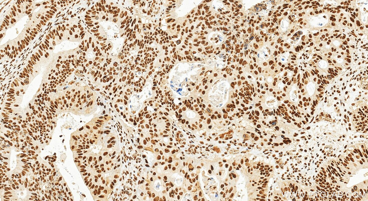 Immunohistochemistry (IHC) staining of human colon cancer tissue using PLAGL2 Monoclonal antibody (68606-1-Ig)