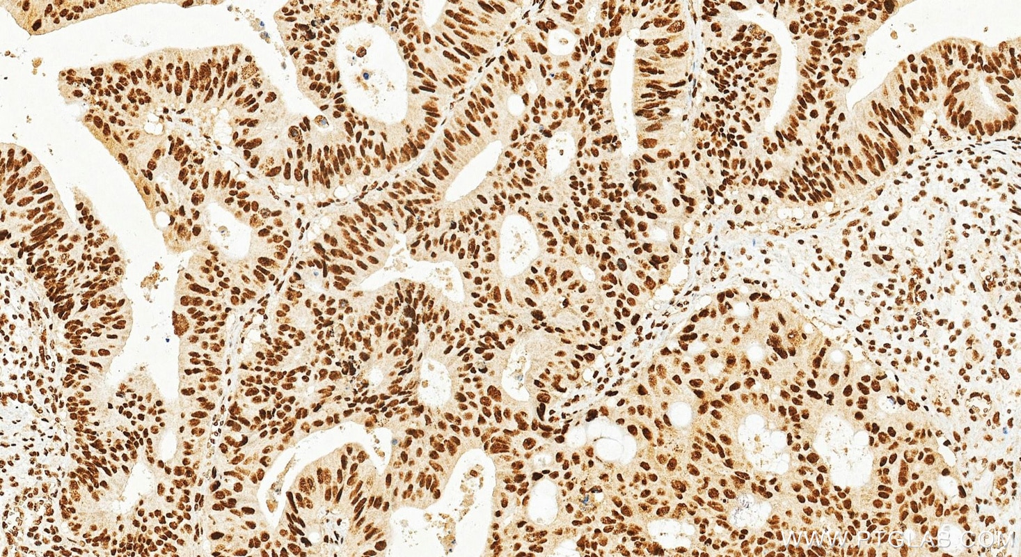Immunohistochemistry (IHC) staining of human colon cancer tissue using PLAGL2 Monoclonal antibody (68606-1-Ig)