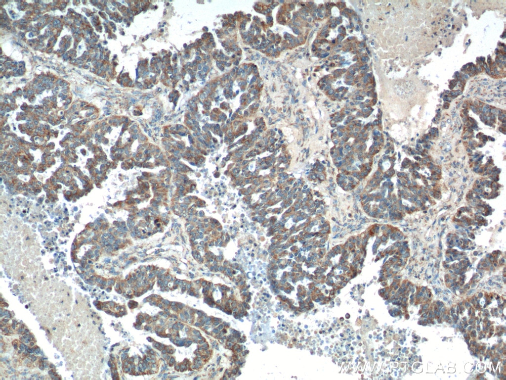 Immunohistochemistry (IHC) staining of human ovary tumor tissue using tPA Polyclonal antibody (10147-1-AP)