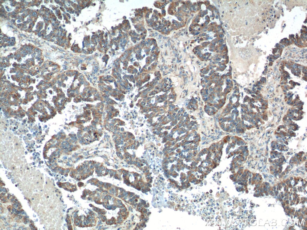 IHC staining of human ovary tumor using 10147-1-AP