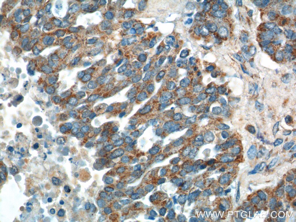 Immunohistochemistry (IHC) staining of human ovary tumor tissue using tPA Polyclonal antibody (10147-1-AP)