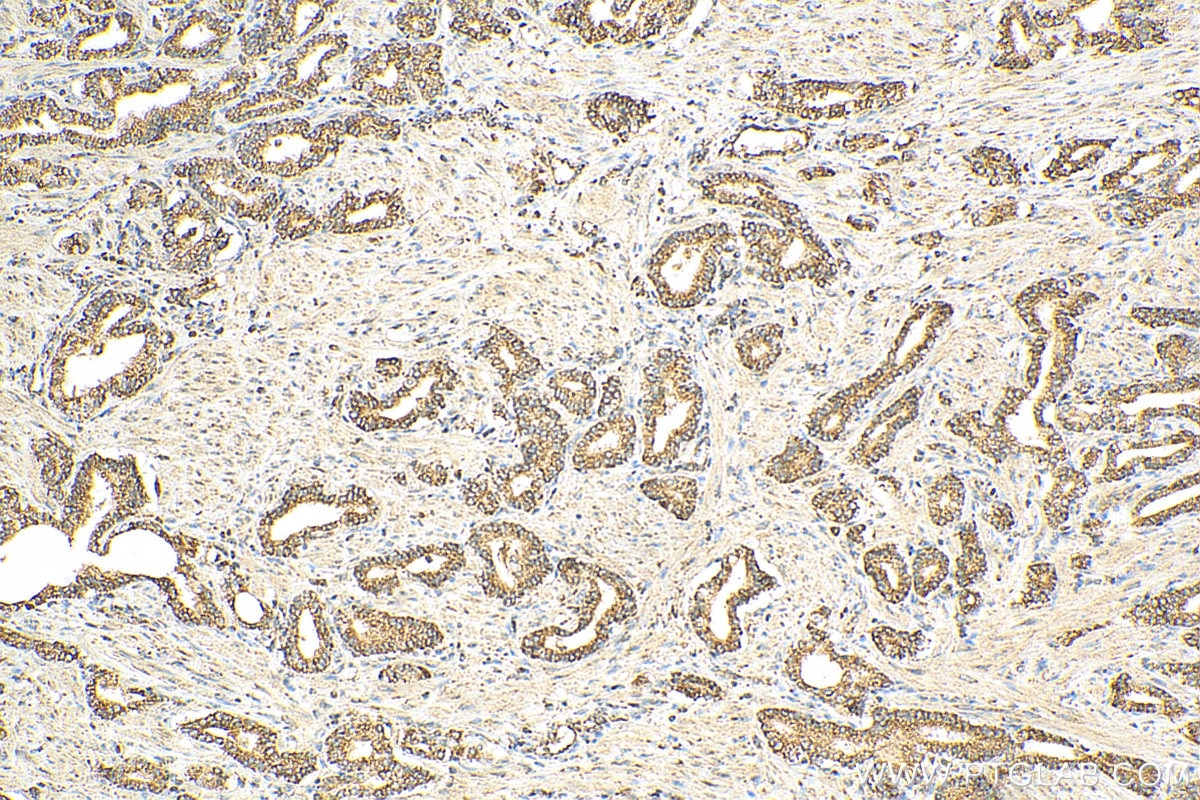 Immunohistochemistry (IHC) staining of human prostate cancer tissue using uPA/Urokinase Polyclonal antibody (17968-1-AP)