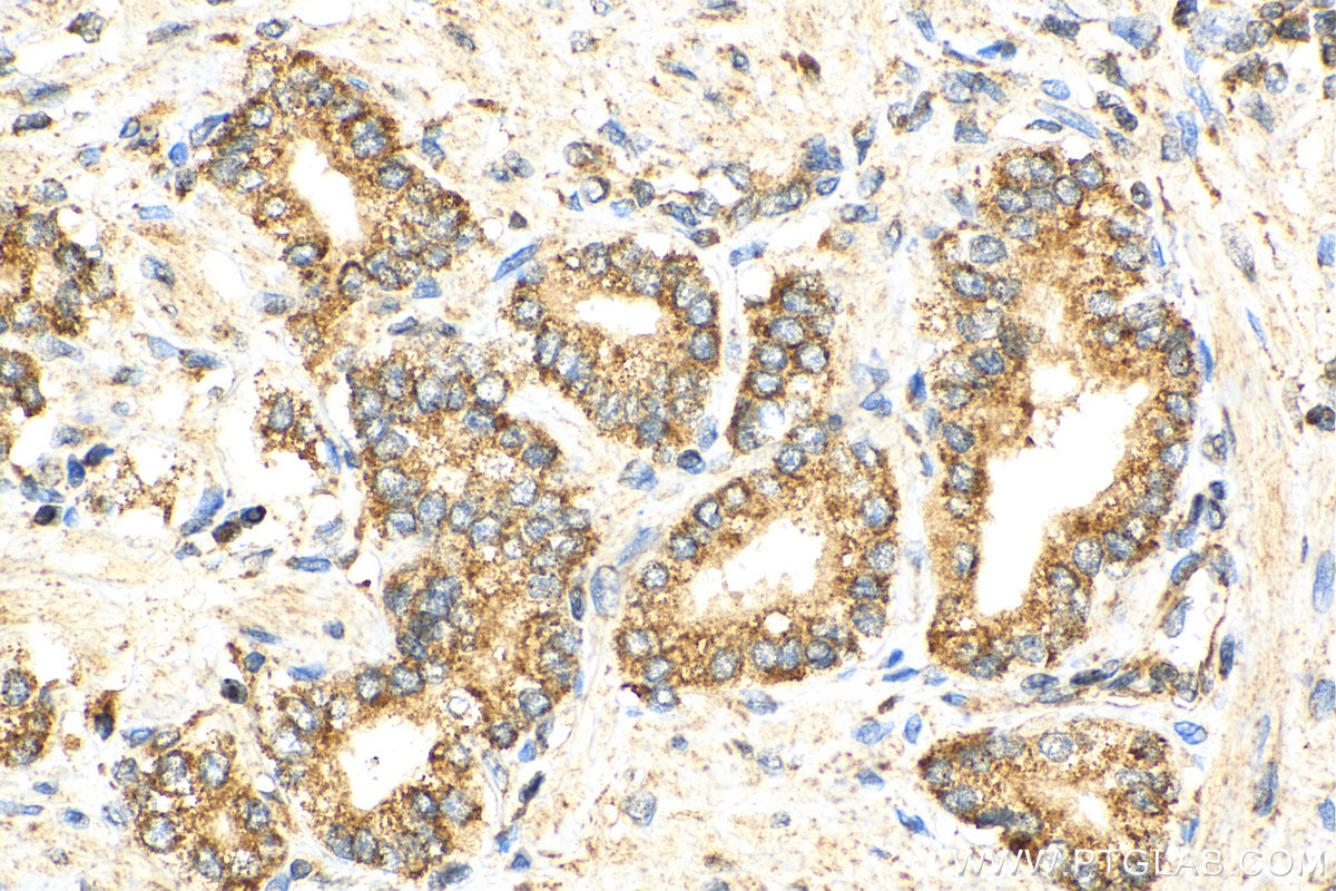 Immunohistochemistry (IHC) staining of human prostate cancer tissue using uPA/Urokinase Polyclonal antibody (17968-1-AP)