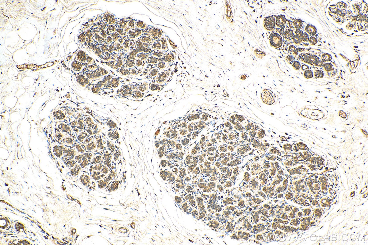 Immunohistochemistry (IHC) staining of human breast cancer tissue using uPA/Urokinase Polyclonal antibody (17968-1-AP)