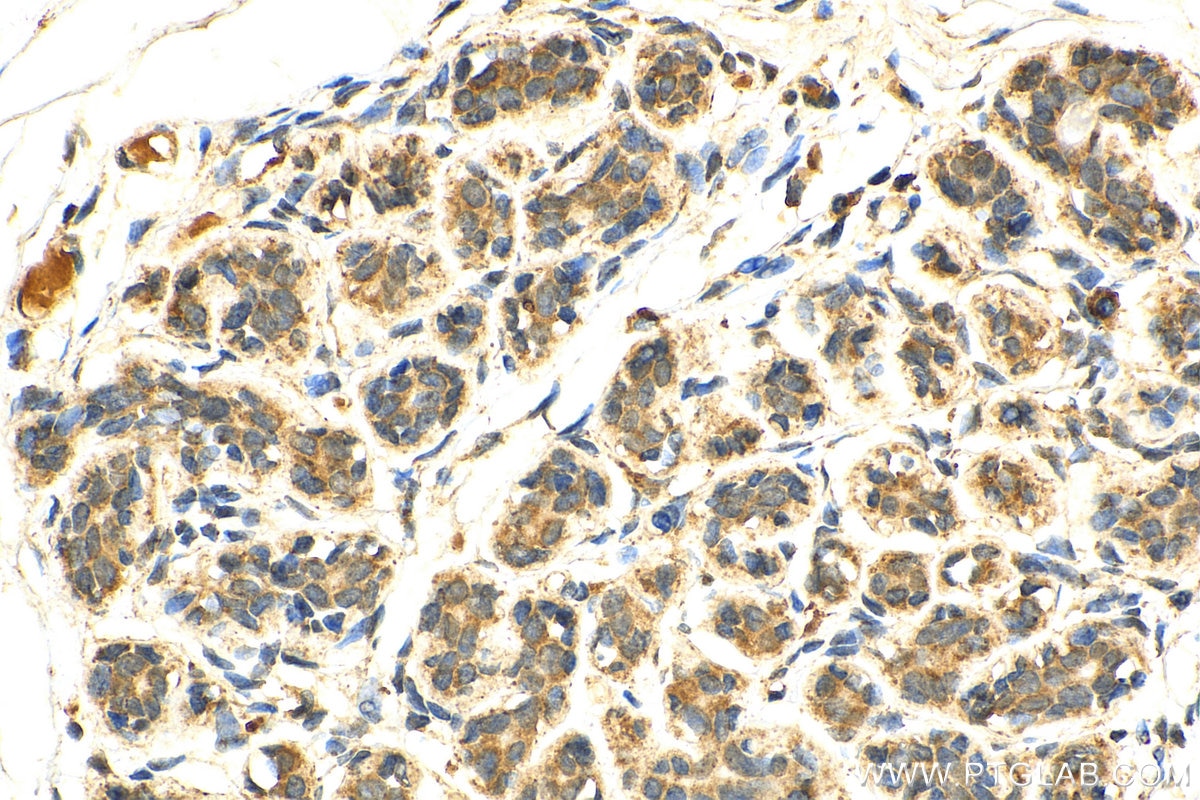 IHC staining of human breast cancer using 17968-1-AP