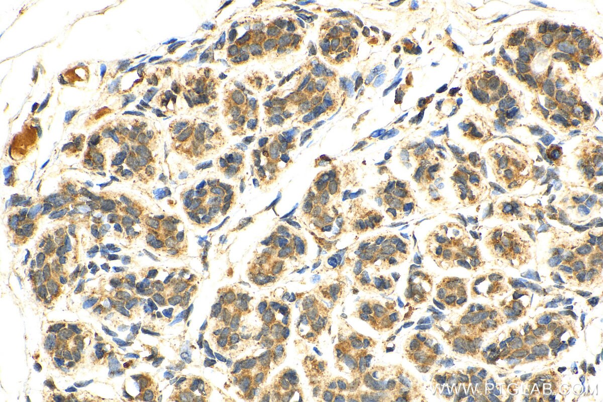 Immunohistochemistry (IHC) staining of human breast cancer tissue using uPA/Urokinase Polyclonal antibody (17968-1-AP)