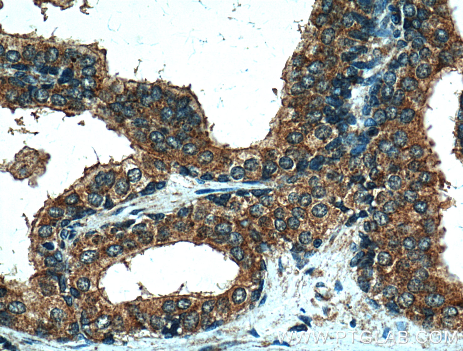 Immunohistochemistry (IHC) staining of human prostate hyperplasia tissue using PLB1 Polyclonal antibody (26835-1-AP)