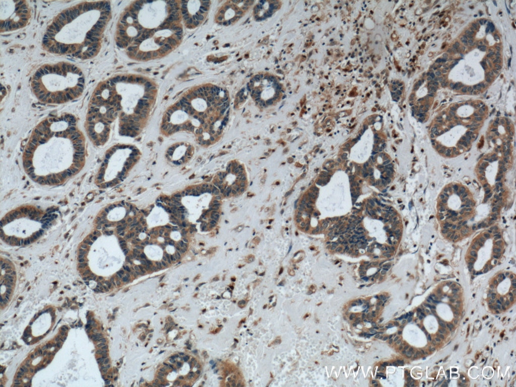 Immunohistochemistry (IHC) staining of human breast cancer tissue using Phospholipase C Beta 1 Polyclonal antibody (26551-1-AP)