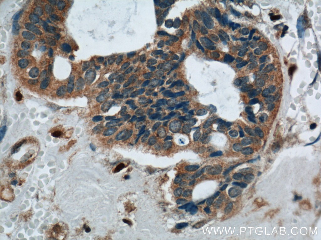 Immunohistochemistry (IHC) staining of human breast cancer tissue using Phospholipase C Beta 1 Polyclonal antibody (26551-1-AP)