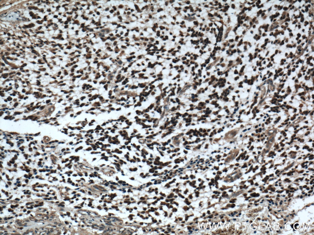 Immunohistochemistry (IHC) staining of human gliomas tissue using Phospholipase C Beta 1 Polyclonal antibody (26551-1-AP)