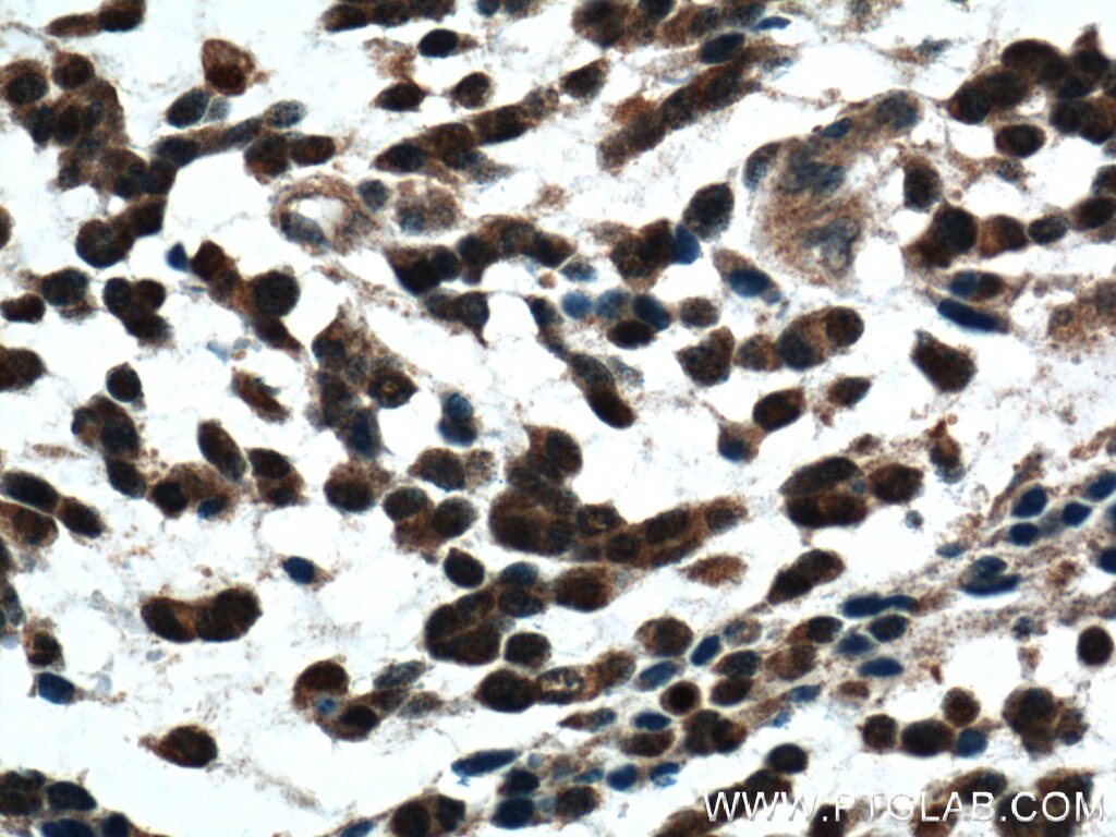 IHC staining of human gliomas using 26551-1-AP