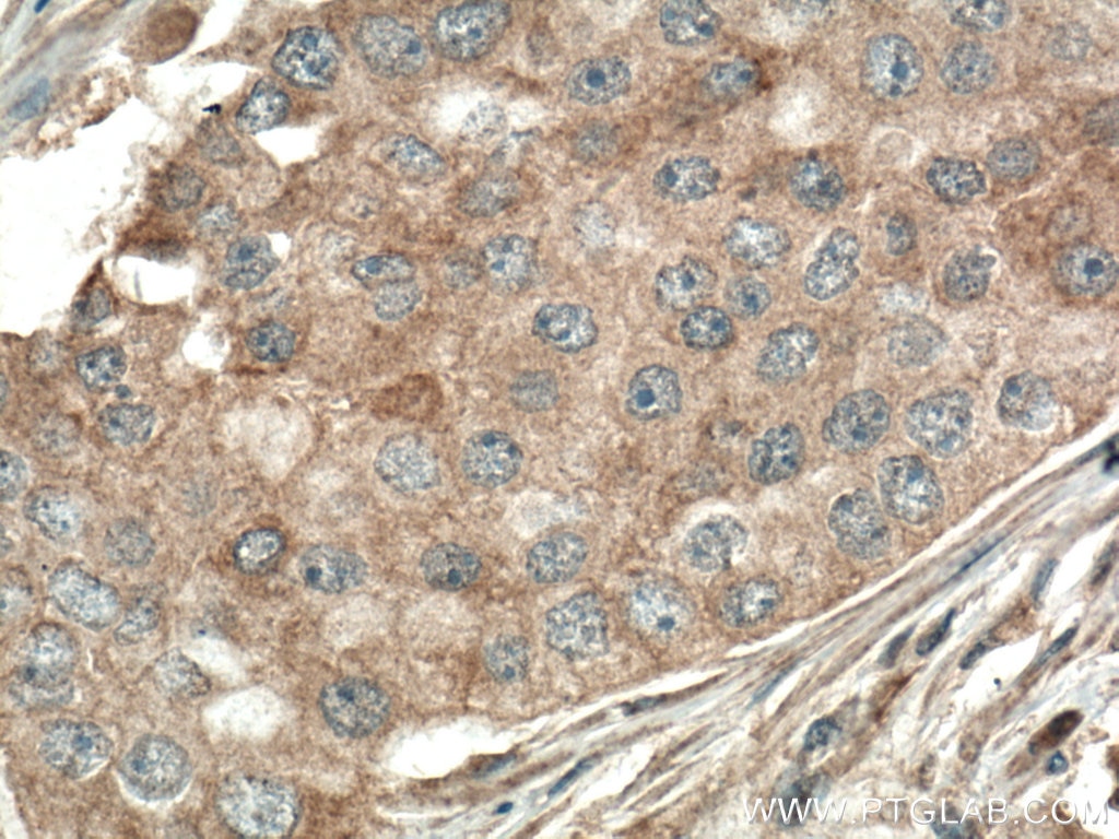 Immunohistochemistry (IHC) staining of human breast cancer tissue using PLCB3 Monoclonal antibody (66668-1-Ig)