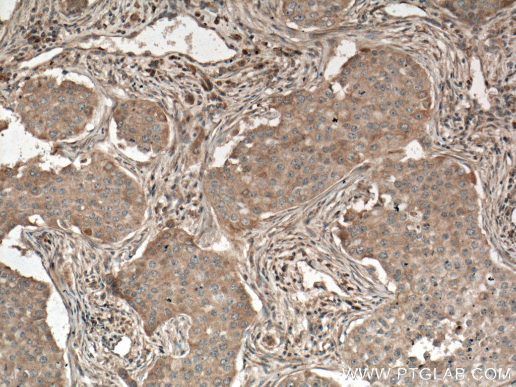 Immunohistochemistry (IHC) staining of human breast cancer tissue using PLCB3 Monoclonal antibody (66668-1-Ig)