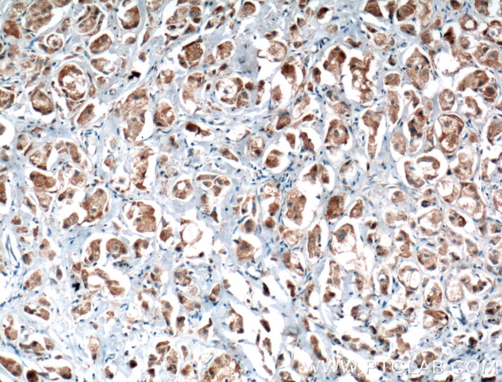 Immunohistochemistry (IHC) staining of human breast cancer tissue using PLCD1 Polyclonal antibody (14228-1-AP)