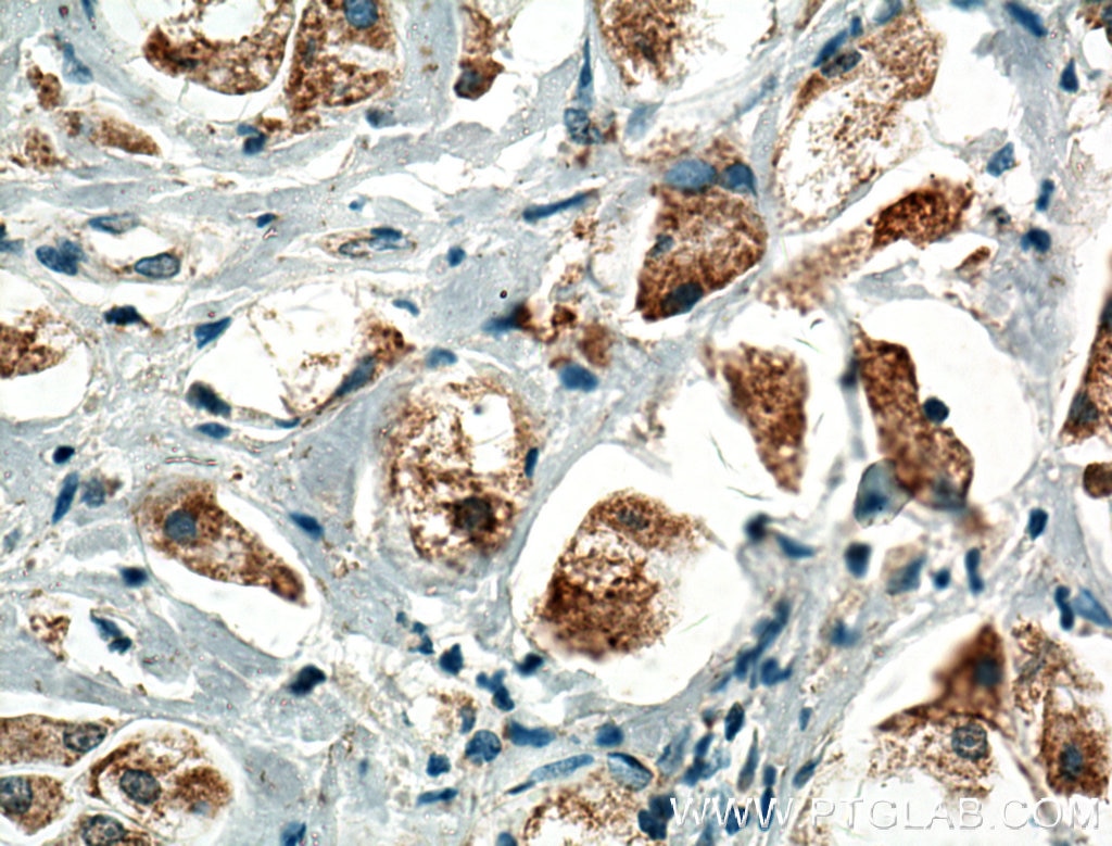 Immunohistochemistry (IHC) staining of human breast cancer tissue using PLCD1 Polyclonal antibody (14228-1-AP)