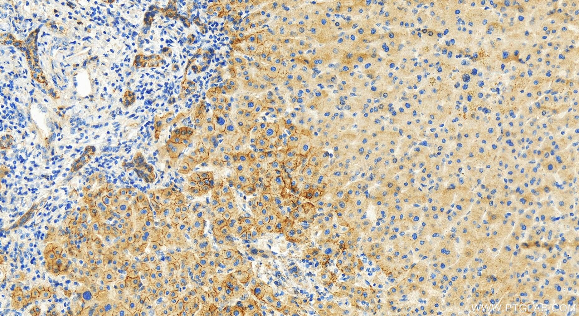 Immunohistochemistry (IHC) staining of human intrahepatic cholangiocarcinoma tissue using PLCD3 Polyclonal antibody (16792-1-AP)