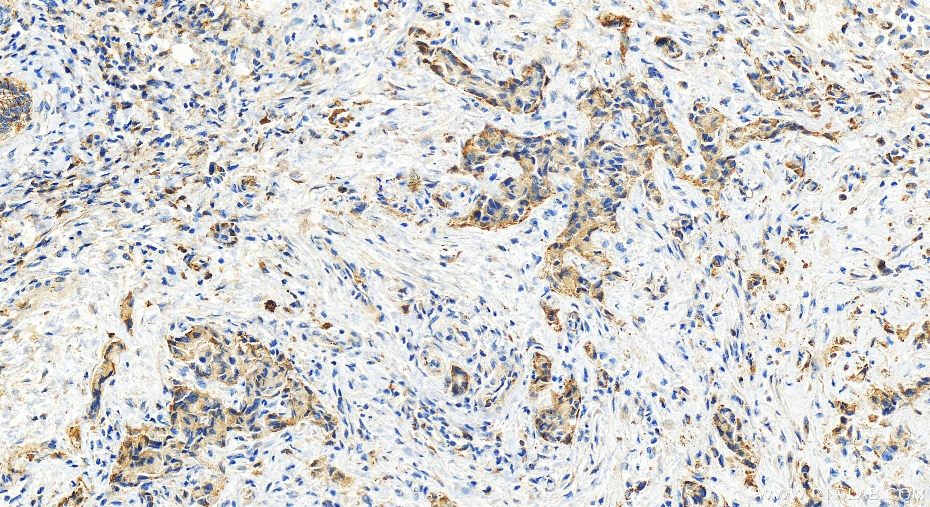 Immunohistochemistry (IHC) staining of human intrahepatic cholangiocarcinoma tissue using PLCD3 Polyclonal antibody (16792-1-AP)
