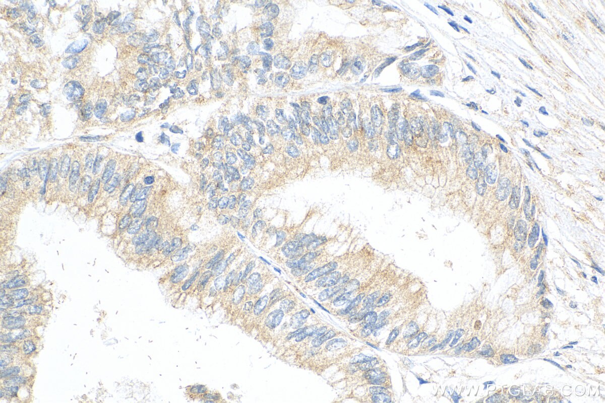 IHC staining of human pancreas cancer using 10589-2-AP