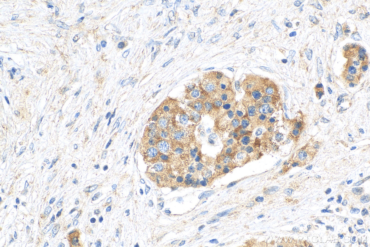 Immunohistochemistry (IHC) staining of human pancreas cancer tissue using PLCD4 Polyclonal antibody (10589-2-AP)