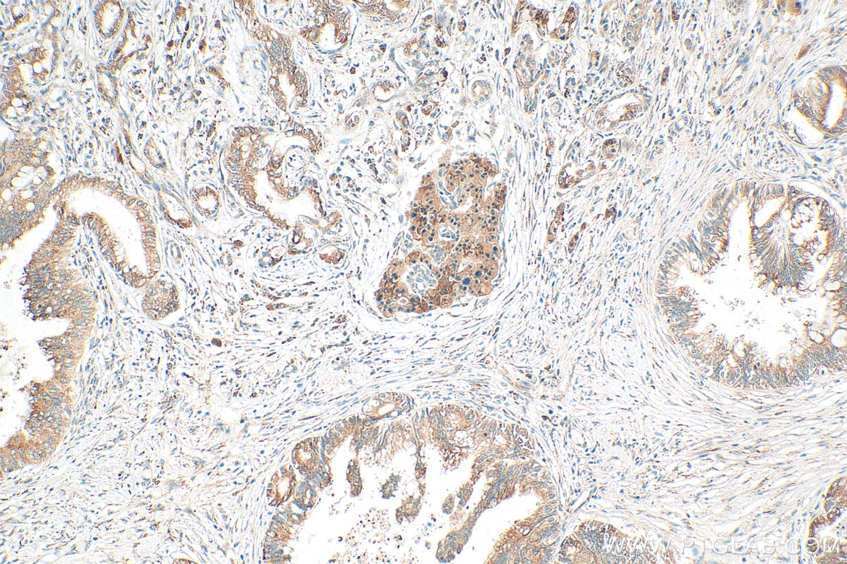 Immunohistochemistry (IHC) staining of human pancreas cancer tissue using PLCD4 Polyclonal antibody (30133-1-AP)