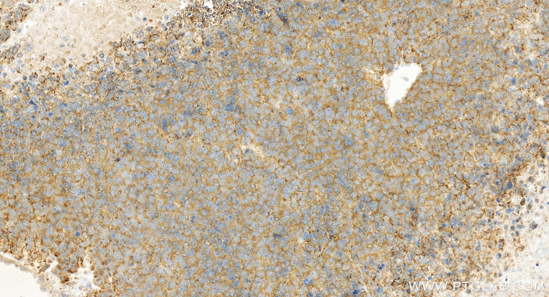 Immunohistochemical analysis of paraffin-embedded human liver cancer tissue slide using 84941-1-RR (PLCG1 antibody) at dilution of 1:500 (under 20x lens). Heat mediated antigen retrieval with Tris-EDTA buffer (pH 9.0). This data was developed using the same antibody clone with 84941-1-PBS in a different storage buffer formulation. Immunohistochemistry (IHC) staining of human liver cancer tissue using PLCG1 Recombinant antibody (84941-1-RR)