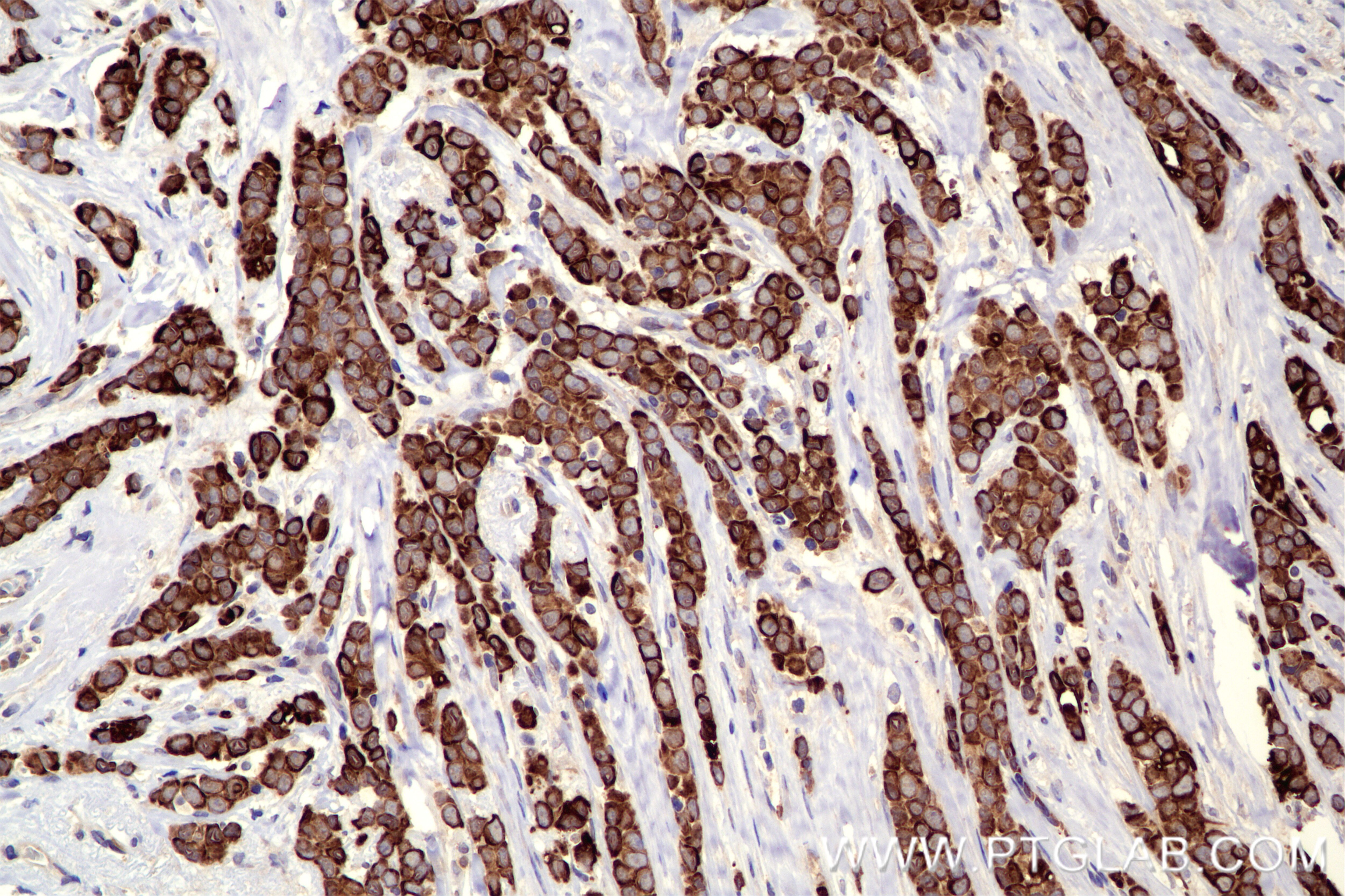 Immunohistochemical analysis of paraffin-embedded human breast cancer tissue slide using 84941-1-RR (PLCG1 antibody) at dilution of 1:500 (under 20x lens). Heat mediated antigen retrieval with Tris-EDTA buffer (pH 9.0). This data was developed using the same antibody clone with 84941-1-PBS in a different storage buffer formulation. Immunohistochemistry (IHC) staining of human breast cancer tissue using PLCG1 Recombinant antibody (84941-1-RR)