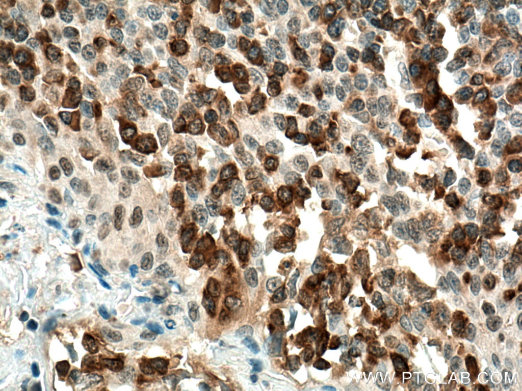 Immunohistochemistry (IHC) staining of human tonsillitis tissue using PLCG2 Polyclonal antibody (27173-1-AP)