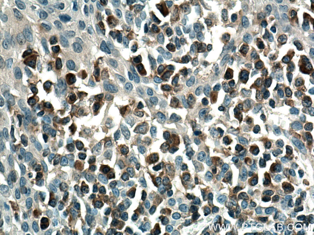 Immunohistochemistry (IHC) staining of human tonsillitis tissue using PLCG2 Monoclonal antibody (67011-1-Ig)